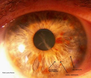 Iridología. Signos reflejos en el iris